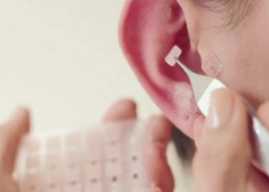 AURICULOTERAPIA